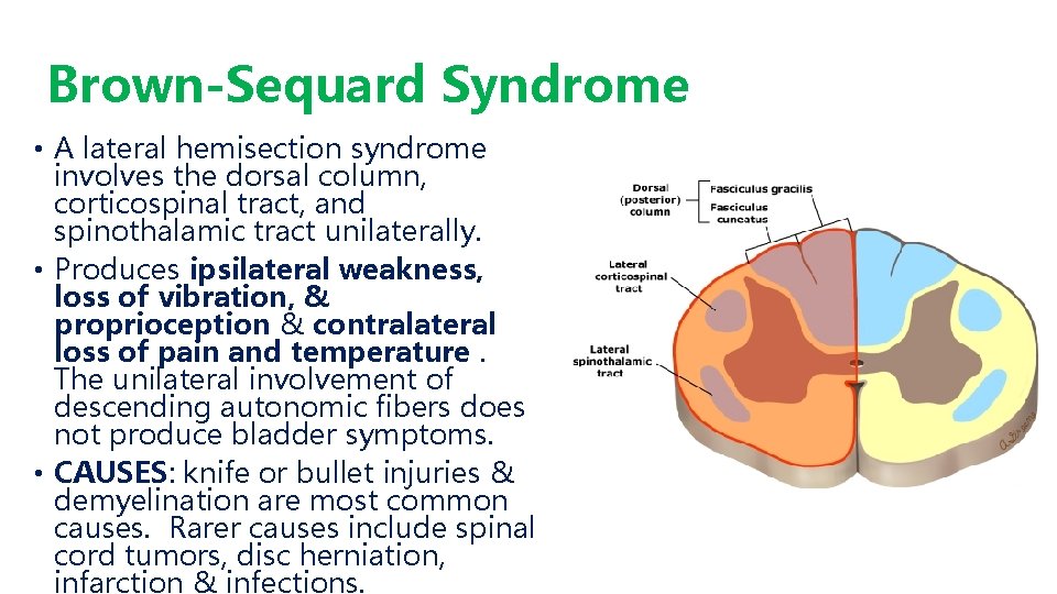 Brown-Sequard Syndrome • A lateral hemisection syndrome involves the dorsal column, corticospinal tract, and