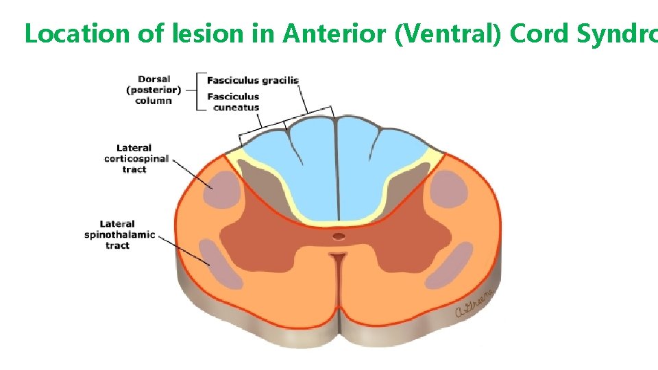 Location of lesion in Anterior (Ventral) Cord Syndro 