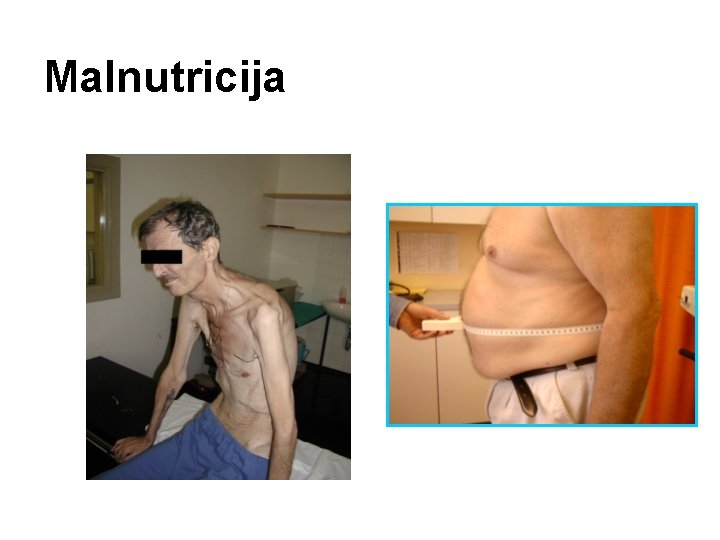 Malnutricija 