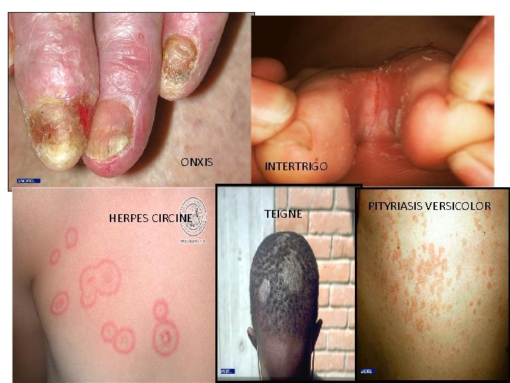 ONXIS HERPES CIRCINE INTERTRIGO TEIGNE PITYRIASIS VERSICOLOR 