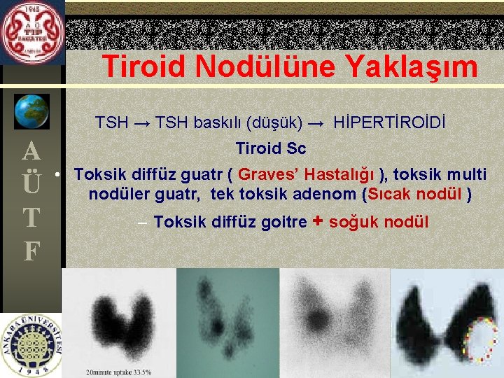 Tiroid Nodülüne Yaklaşım TSH → TSH baskılı (düşük) → HİPERTİROİDİ A Ü T F