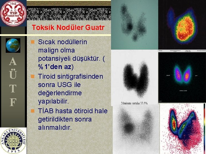 Toksik Nodüler Guatr n Sıcak nodüllerin A Ü T F malign olma potansiyeli düşüktür.