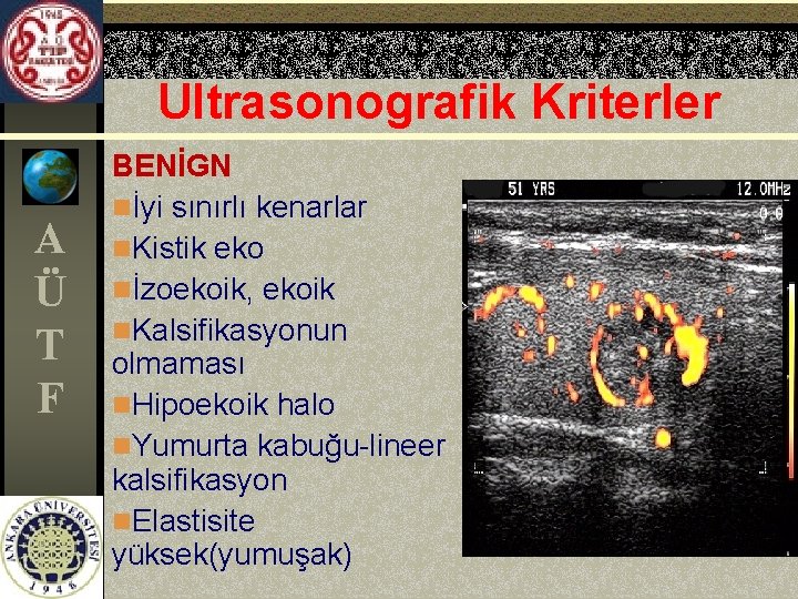 Ultrasonografik Kriterler A Ü T F BENİGN nİyi sınırlı kenarlar n. Kistik eko nİzoekoik,