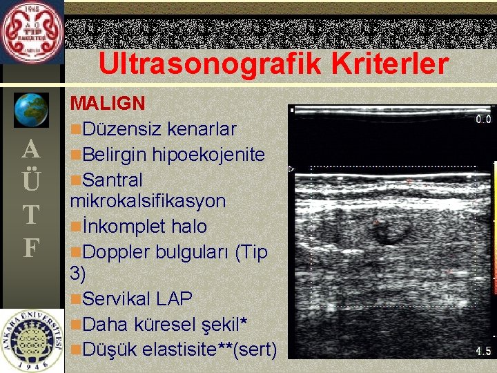 Ultrasonografik Kriterler A Ü T F MALIGN n. Düzensiz kenarlar n. Belirgin hipoekojenite n.