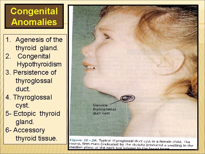 Congenital Anomalies 1. Agenesis of the thyroid gland. 2. Congenital Hypothyroidism 3. Persistence of