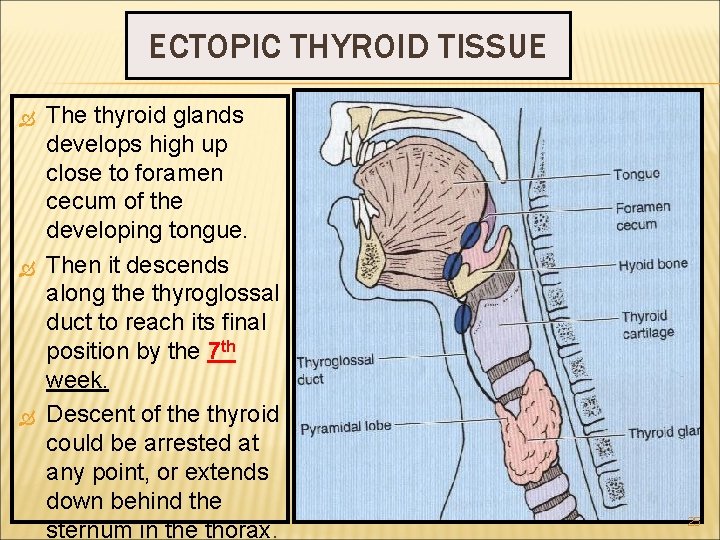 ECTOPIC THYROID TISSUE The thyroid glands develops high up close to foramen cecum of