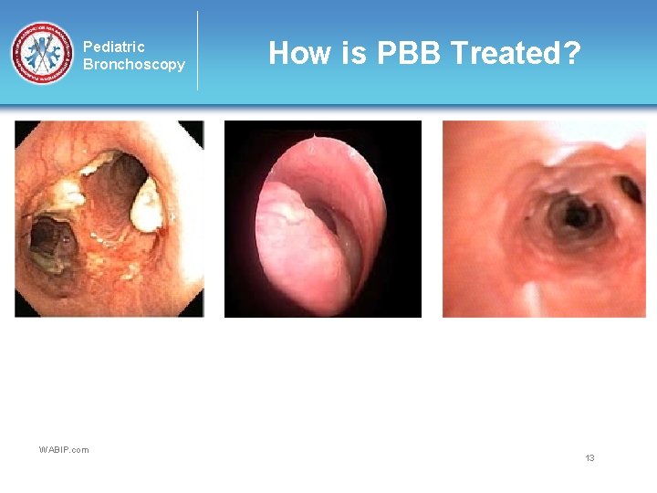 Pediatric Bronchoscopy WABIP. com How is PBB Treated? 13 