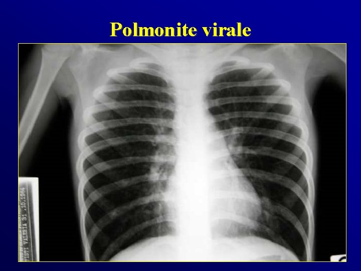 Polmonite virale 