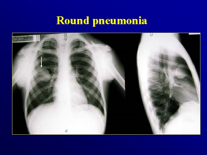 Round pneumonia 