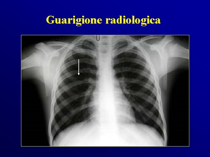 Guarigione radiologica 