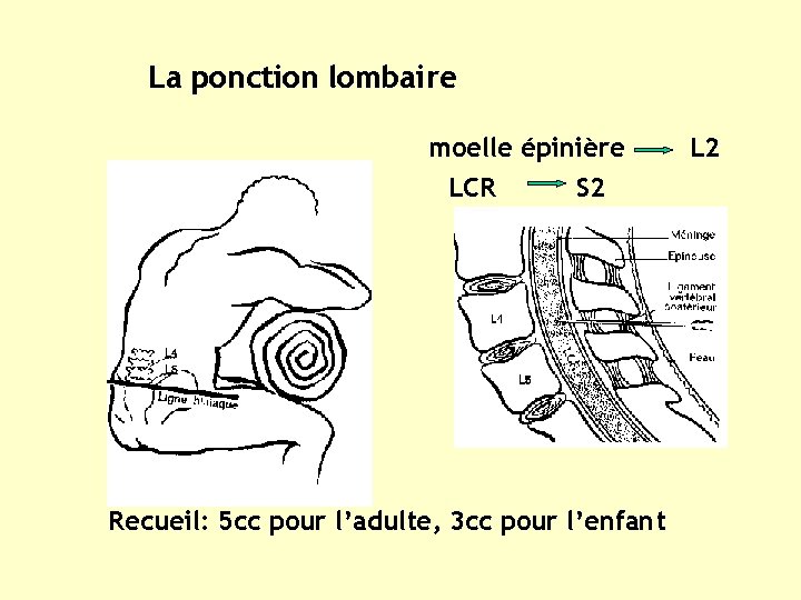 La ponction lombaire moelle épinière LCR S 2 Recueil: 5 cc pour l’adulte, 3