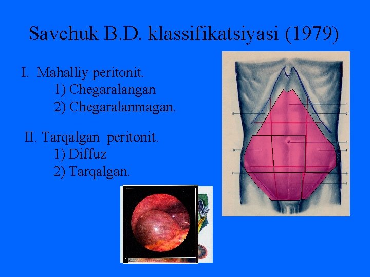 Savchuk B. D. klassifikatsiyasi (1979) I. Mahalliy peritonit. 1) Chegaralangan 2) Chegaralanmagan. II. Tarqalgan