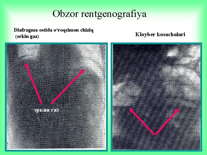 Obzor rentgenografiya Diafragma ostida o‘roqsimon chiziq (erkin gaz) эркин газ Kloyber kosachalari 