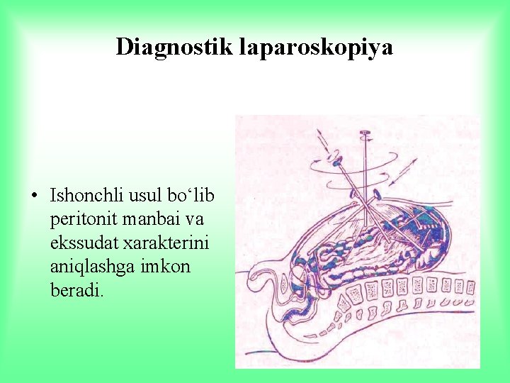 Diagnostik laparoskopiya • Ishonchli usul bo‘lib peritonit manbai va ekssudat xarakterini aniqlashga imkon beradi.