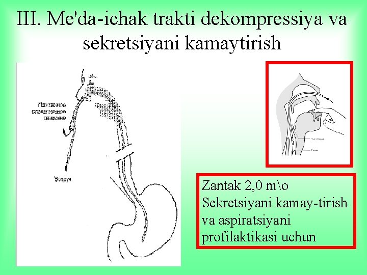 III. Me'da-ichak trakti dekompressiya va sekretsiyani kamaytirish Zantak 2, 0 mo Sekretsiyani kamay-tirish va