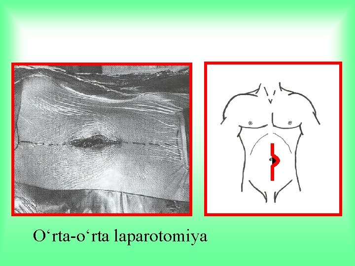 O‘rta-o‘rta laparotomiya 