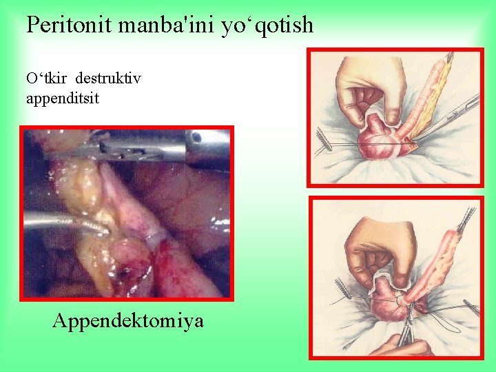 Peritonit manba'ini yo‘qotish O‘tkir destruktiv appenditsit Appendektomiya 