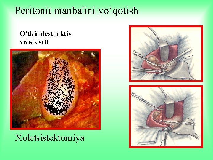 Peritonit manba'ini yo‘qotish O‘tkir destruktiv xoletsistit Xoletsistektomiya 