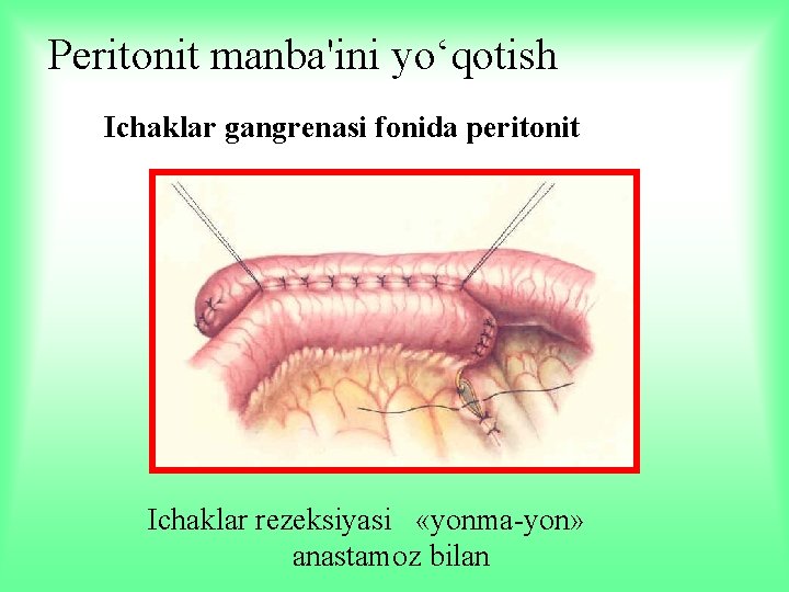 Peritonit manba'ini yo‘qotish Ichaklar gangrenasi fonida peritonit Ichaklar rezeksiyasi «yonma-yon» anastamoz bilan 