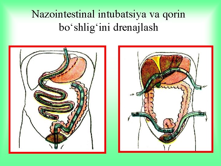 Nazointestinal intubatsiya va qorin bo‘shlig‘ini drenajlash 