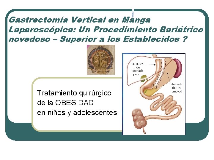 Gastrectomía Vertical en Manga Laparoscópica: Un Procedimiento Bariátrico novedoso – Superior a los Establecidos