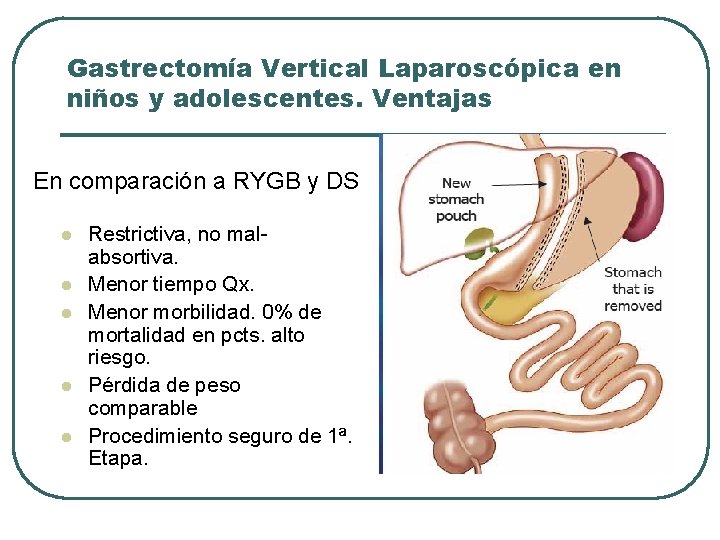 Gastrectomía Vertical Laparoscópica en niños y adolescentes. Ventajas En comparación a RYGB y DS