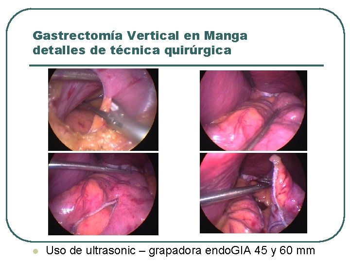Gastrectomía Vertical en Manga detalles de técnica quirúrgica l l Uso de ultrasonic –