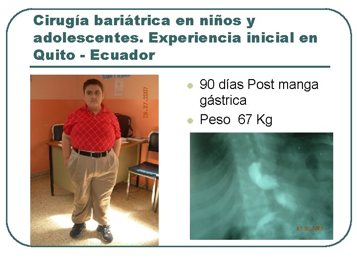 Cirugía bariátrica en niños y adolescentes. Experiencia inicial en Quito - Ecuador l l