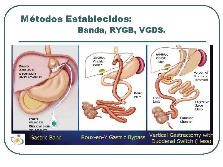 Métodos Establecidos: Banda, RYGB, VGDS. 