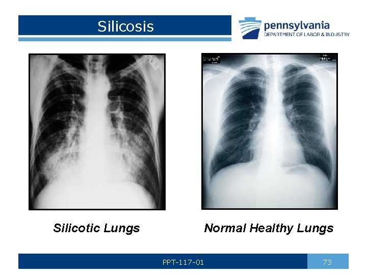 Silicosis Silicotic Lungs Normal Healthy Lungs PPT-117 -01 73 