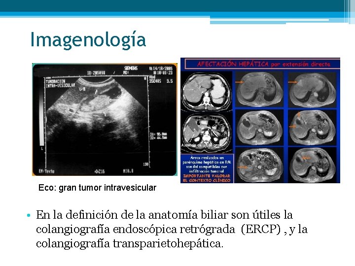 Imagenología Eco: gran tumor intravesicular • En la definición de la anatomía biliar son