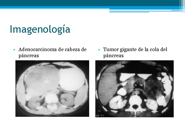 Imagenología • Adenocarcinoma de cabeza de páncreas • Tumor gigante de la cola del
