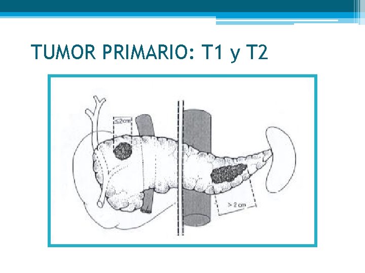 TUMOR PRIMARIO: T 1 y T 2 