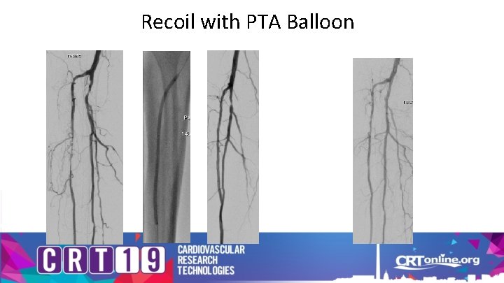 Recoil with PTA Balloon 