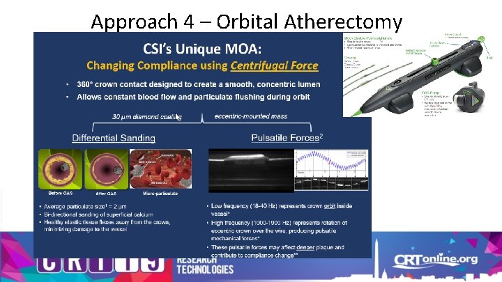 Approach 4 – Orbital Atherectomy 