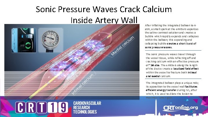 Sonic Pressure Waves Crack Calcium Inside Artery Wall After inflating the integrated balloon to