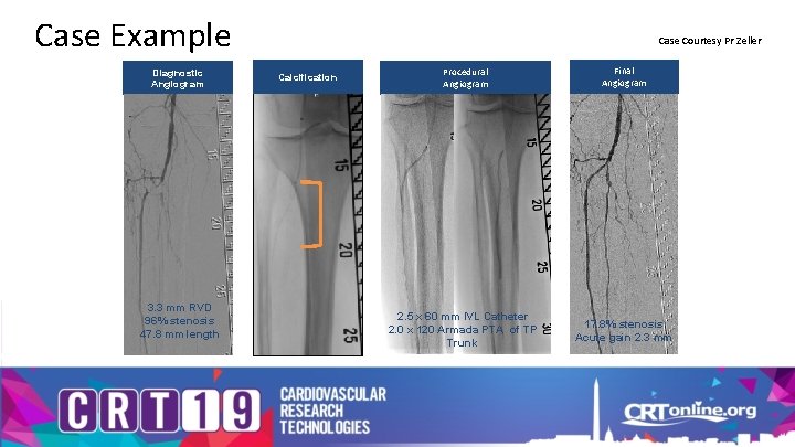 Case Example Diagnostic Angiogram 3. 3 mm RVD 96% stenosis 47. 8 mm length