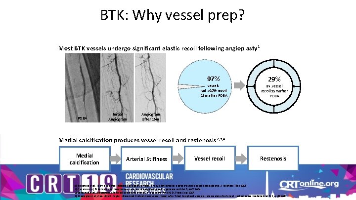 BTK: Why vessel prep? Most BTK vessels undergo significant elastic recoil following angioplasty 1