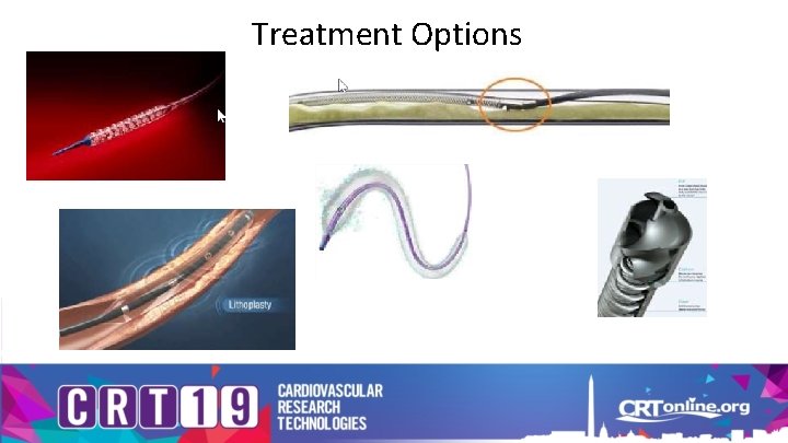 Treatment Options 