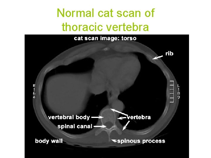 Normal cat scan of thoracic vertebra 