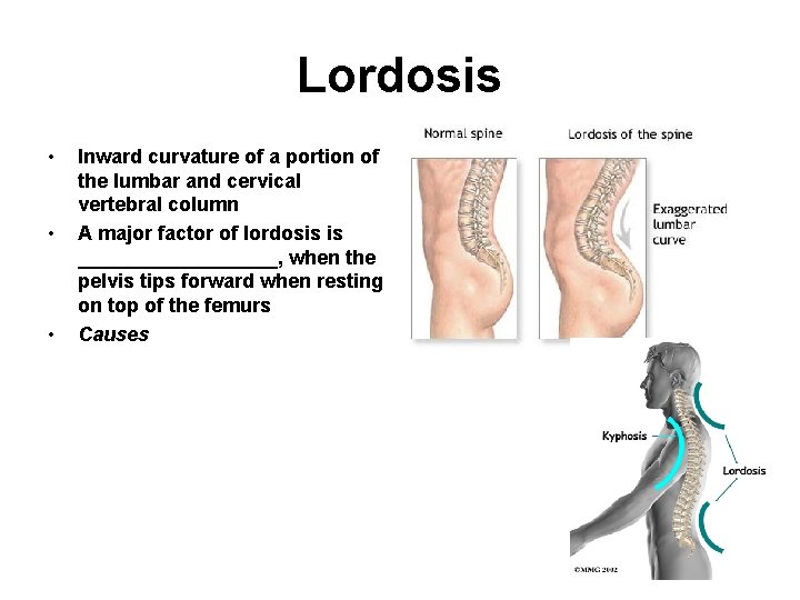Lordosis • • • Inward curvature of a portion of the lumbar and cervical