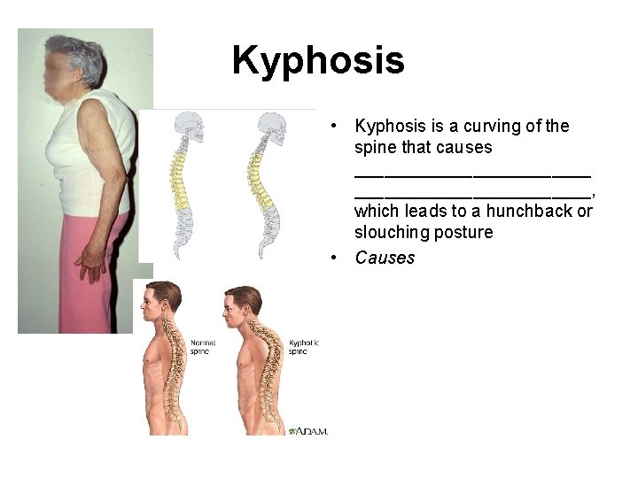 Kyphosis • Kyphosis is a curving of the spine that causes ________________________, which leads