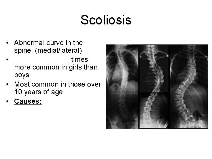 Scoliosis • Abnormal curve in the spine. (medial/lateral) • _______ times more common in