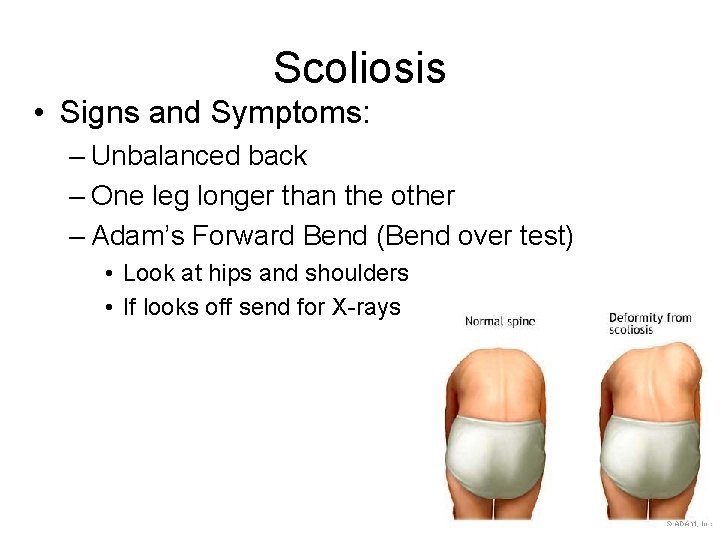 Scoliosis • Signs and Symptoms: – Unbalanced back – One leg longer than the