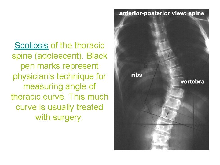 Scoliosis of the thoracic spine (adolescent). Black pen marks represent physician's technique for measuring