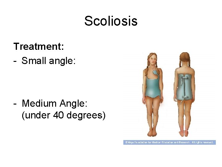 Scoliosis Treatment: - Small angle: - Medium Angle: (under 40 degrees) 