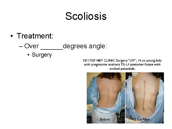 Scoliosis • Treatment: – Over ______degrees angle: • Surgery 