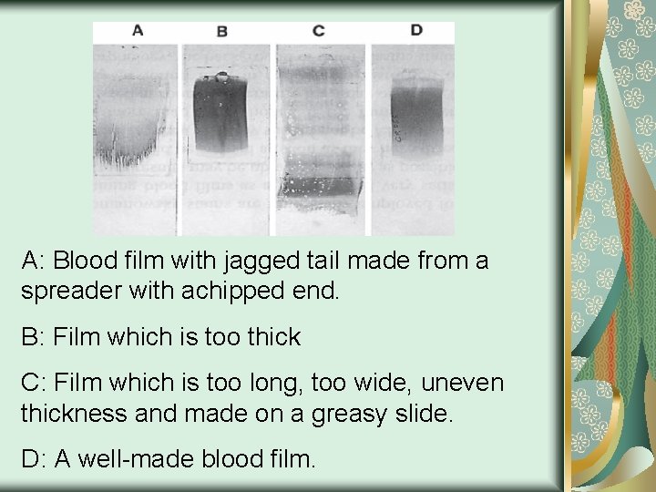 A: Blood film with jagged tail made from a spreader with achipped end. B: