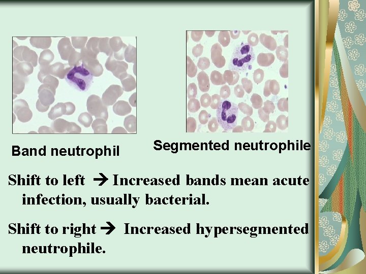 Band neutrophil Segmented neutrophile Shift to left Increased bands mean acute infection, usually bacterial.