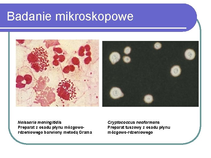 Badanie mikroskopowe Neisseria meningitidis Preparat z osadu płynu mózgowordzeniowego barwiony metodą Grama Cryptococcus neoformans